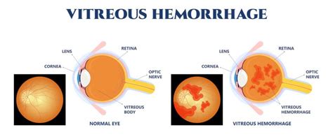 blood leaking from eye|Vitreous Hemorrhage